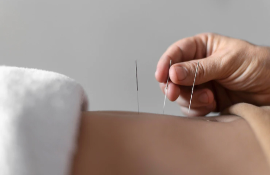 acupuncture treatment