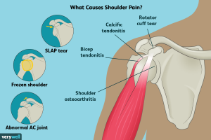 shoulder pain acupuncture ivanhoe