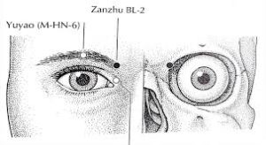 acupuncture headaches