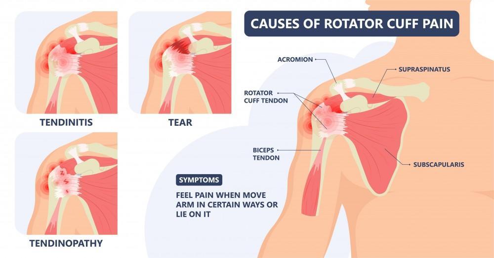 supraspinatus tear
