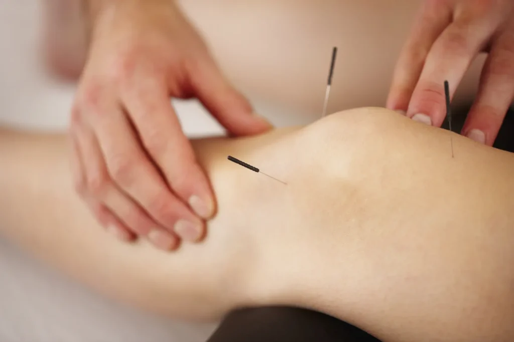 Acupuncture Melbourne Ivanhoe