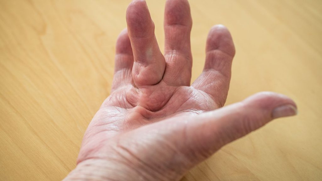 dupuytrens, ivanhoe, physio, acupuncture